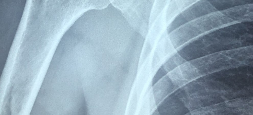 Osteoporosis: A Useful Guide