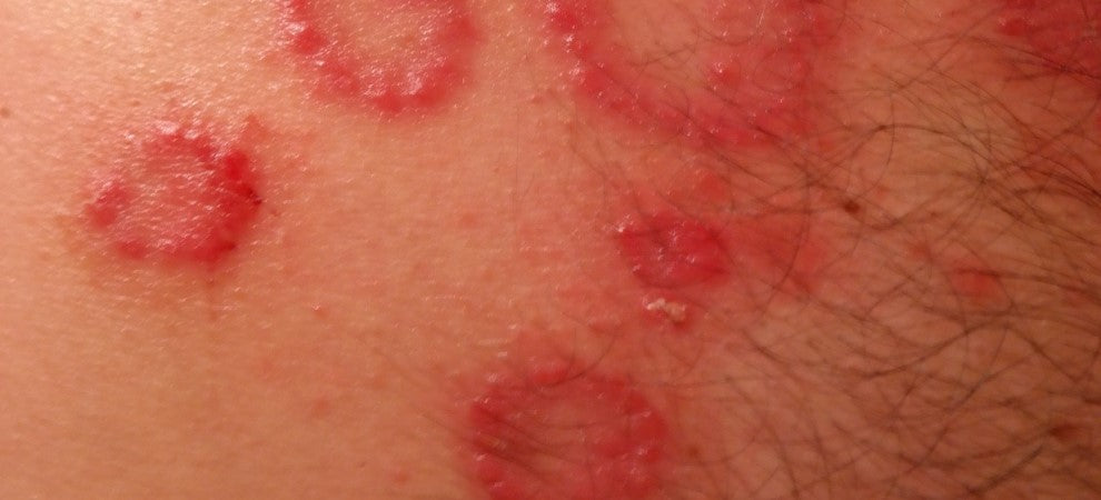 Connected Rash Common Symptoms of Shingles